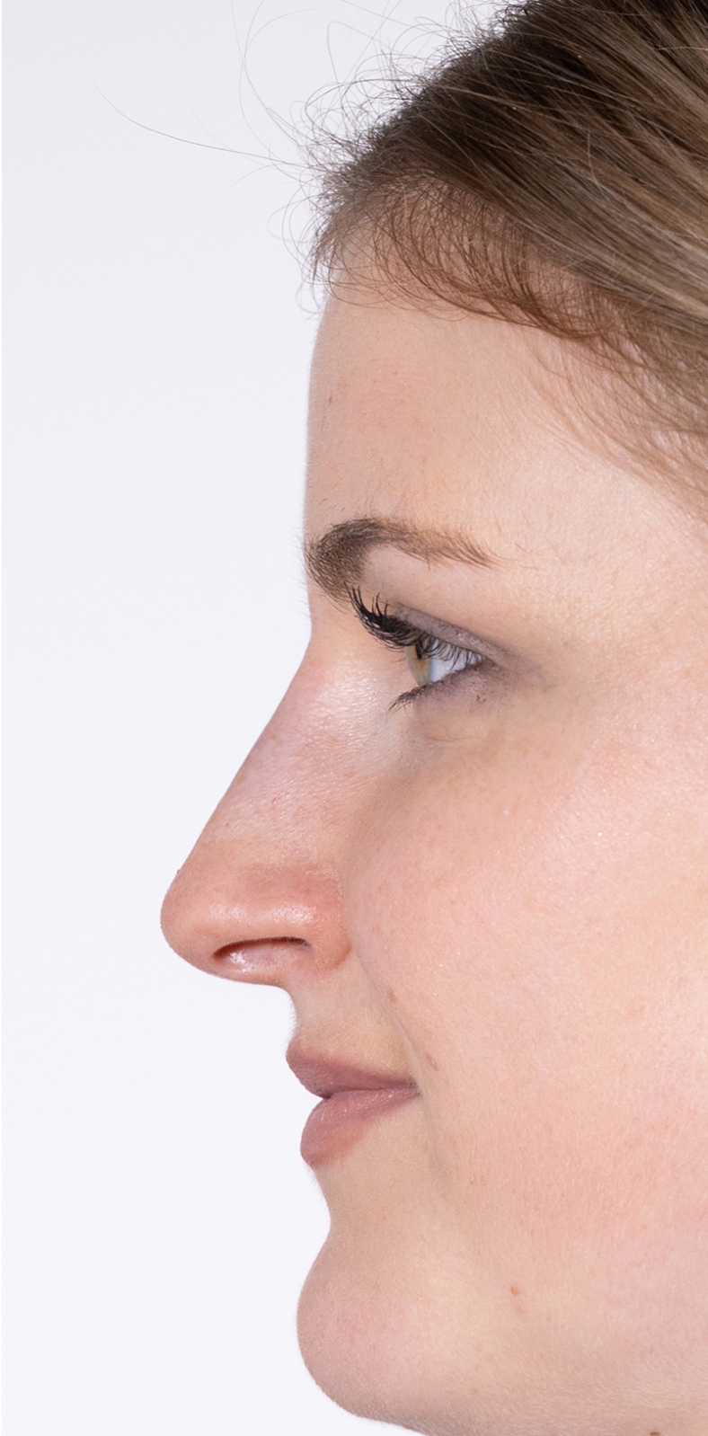 Nekirurška korekcija nosa - poslije, sl. 1 2022
