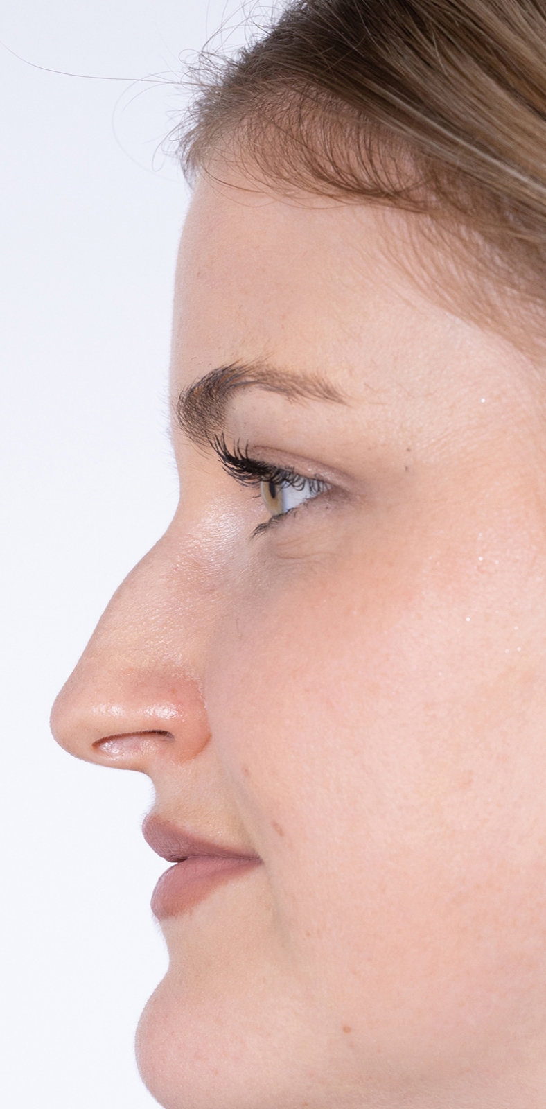 Nekirurška korekcija nosa - prije, sl. 1 2022