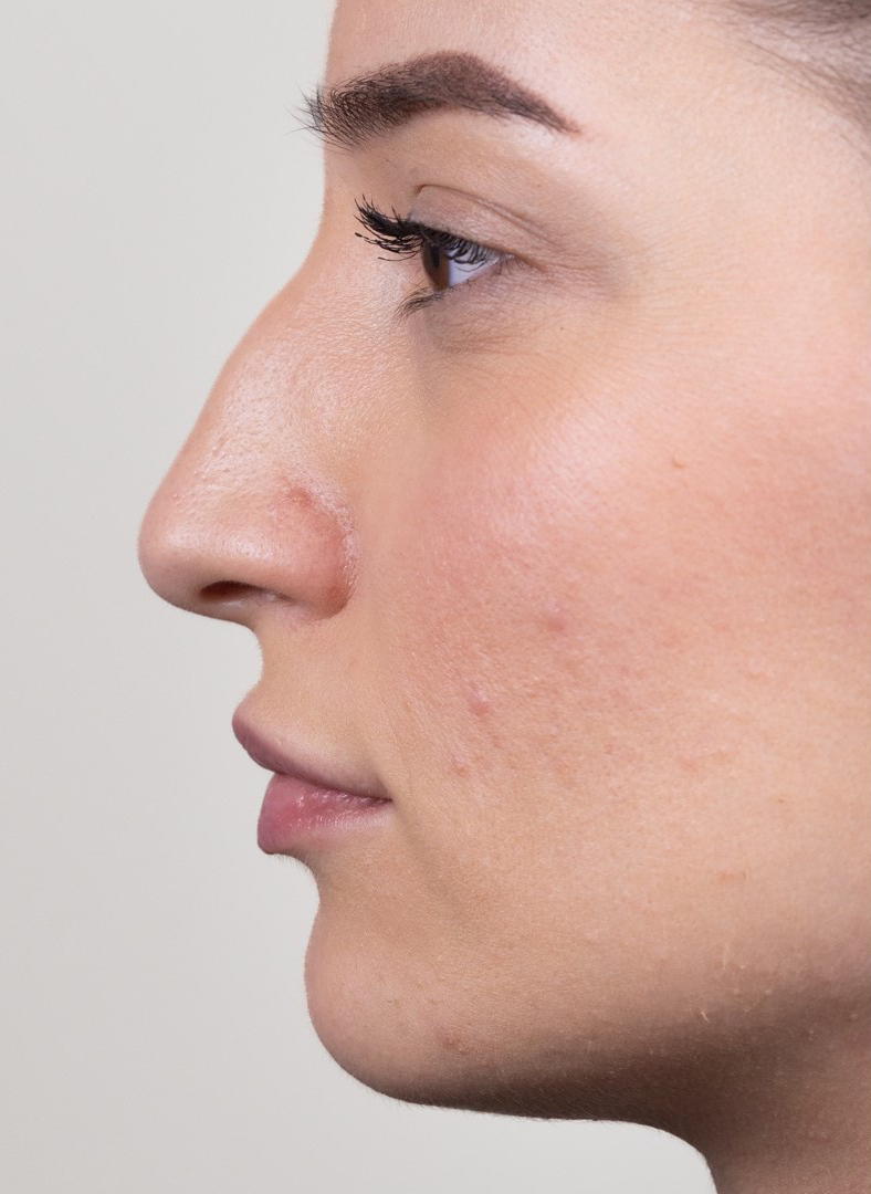Nekirurška korekcija nosa - prije, sl. 1 2023