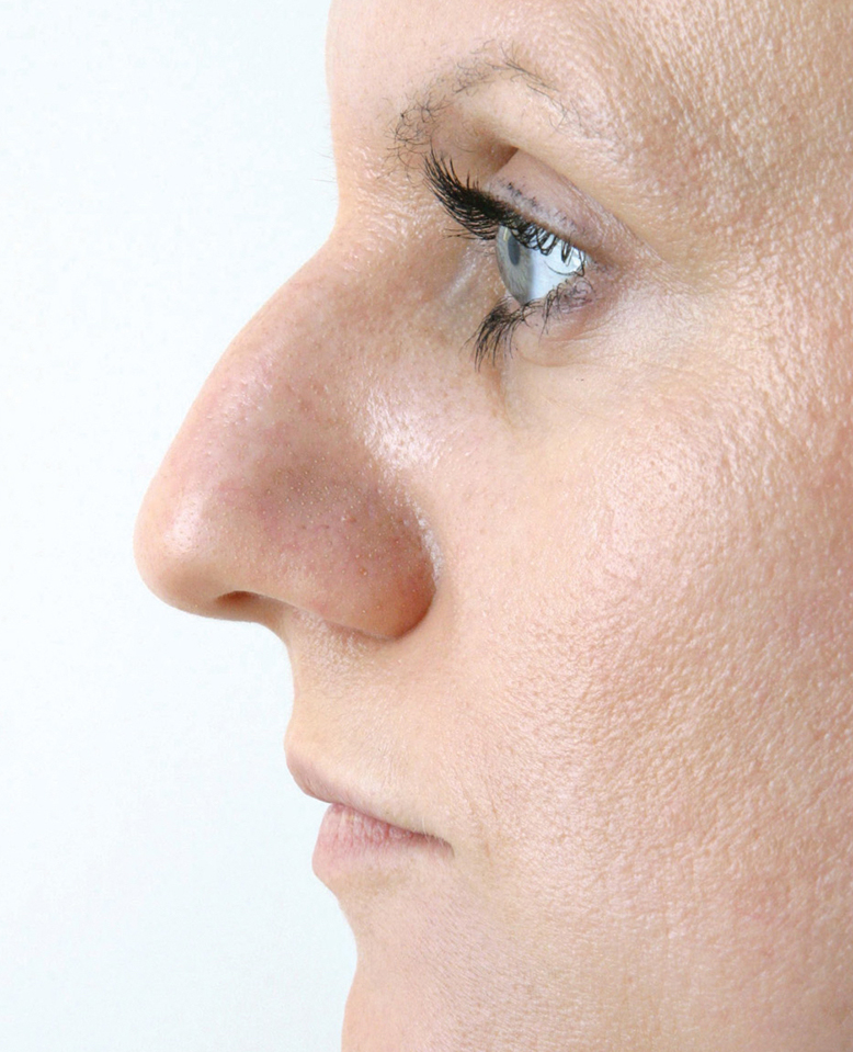 Nekirurška korekcija nosa - prije