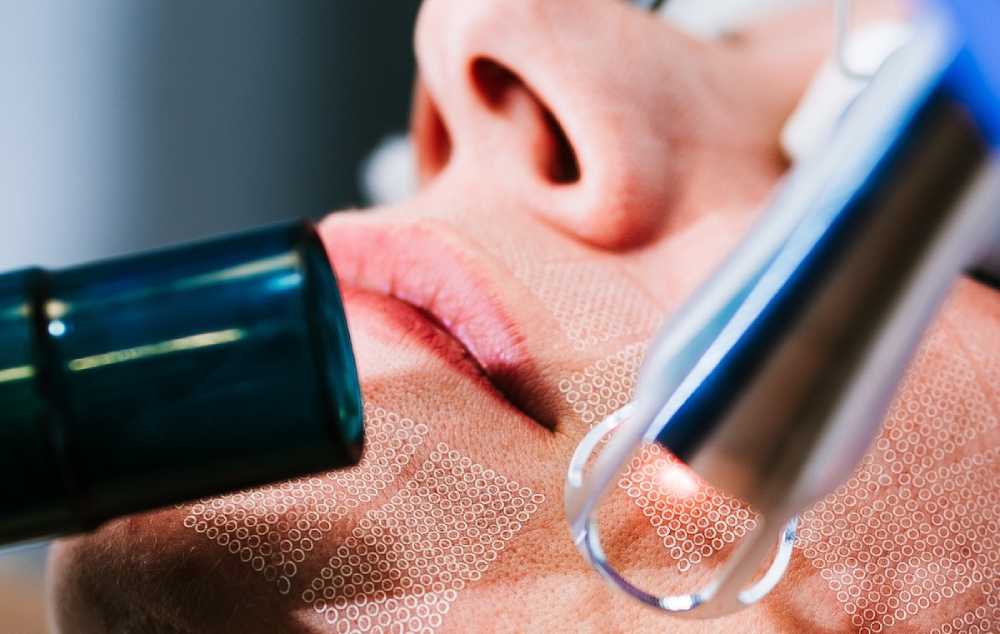 Probala sam revolucionarni UltraClear laser koji briše desetljeća i o kojem svi pričaju