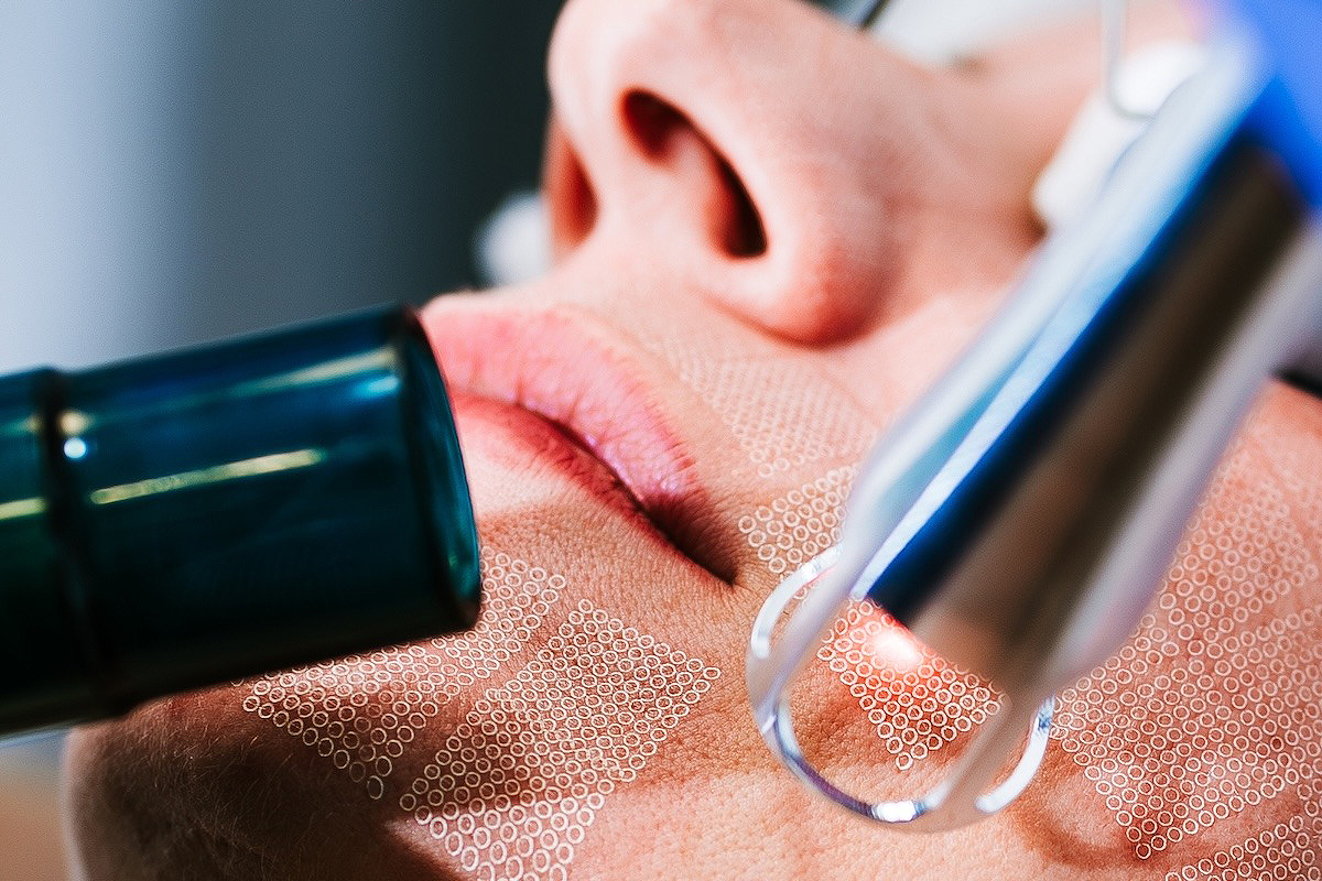 I Tried the UltraClear Laser - Here's How My Skin Reacted