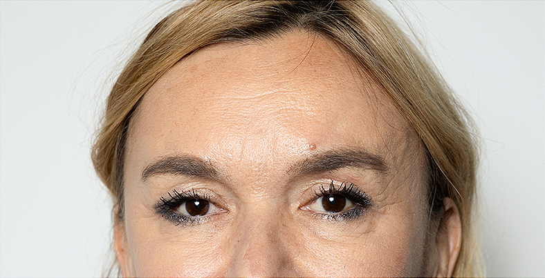 Injekcije za bore, Botox, sl. 3 - poslije