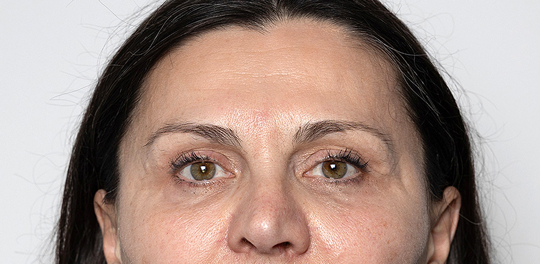 Injekcije za bore, Botox, sl. 1 - poslije