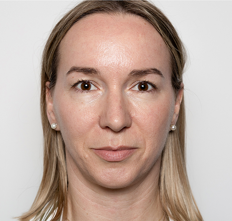 Injekcije za bore, Botox, sl. 1 - poslije