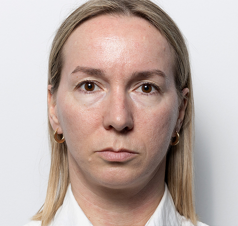 Injekcije za bore, Botox, sl. 1 - prije