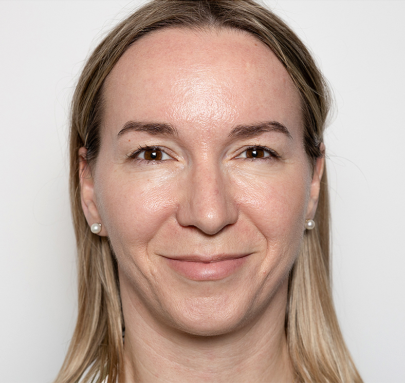 Injekcije za bore, Botox, sl. 1 - poslije