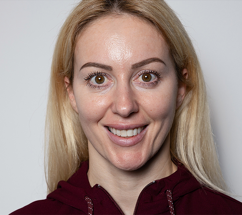 Injekcije za bore, Botox, sl. 1 - poslije