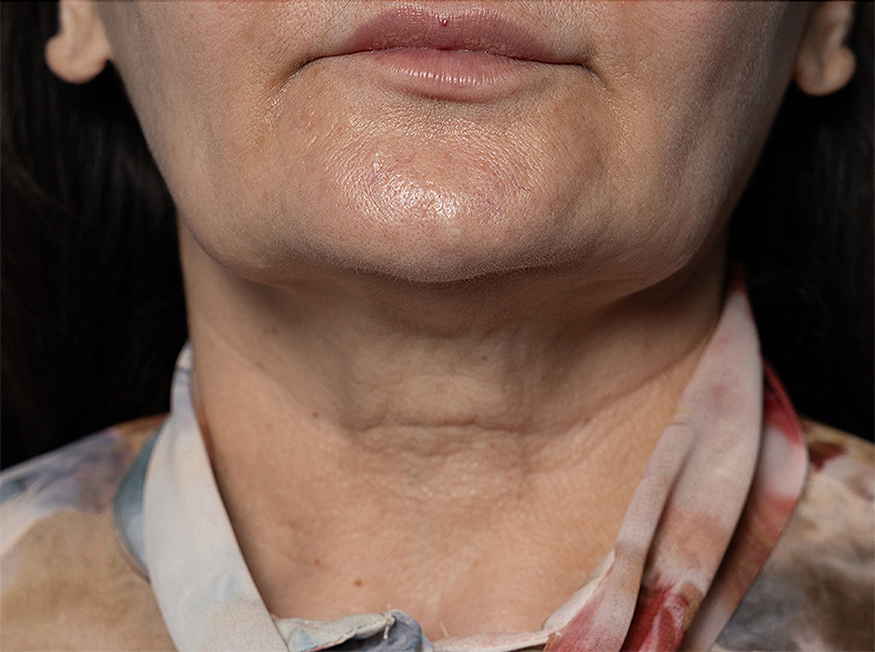 Injekcije za bore, Botox, sl. 4 - poslije