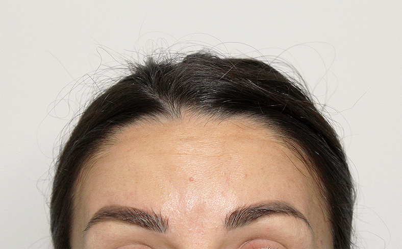 Injekcije za bore, Botox, sl. 1 - poslije