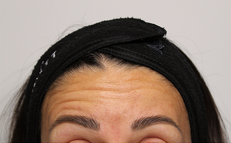 Injekcije za bore, Botox, sl. 1 - prije