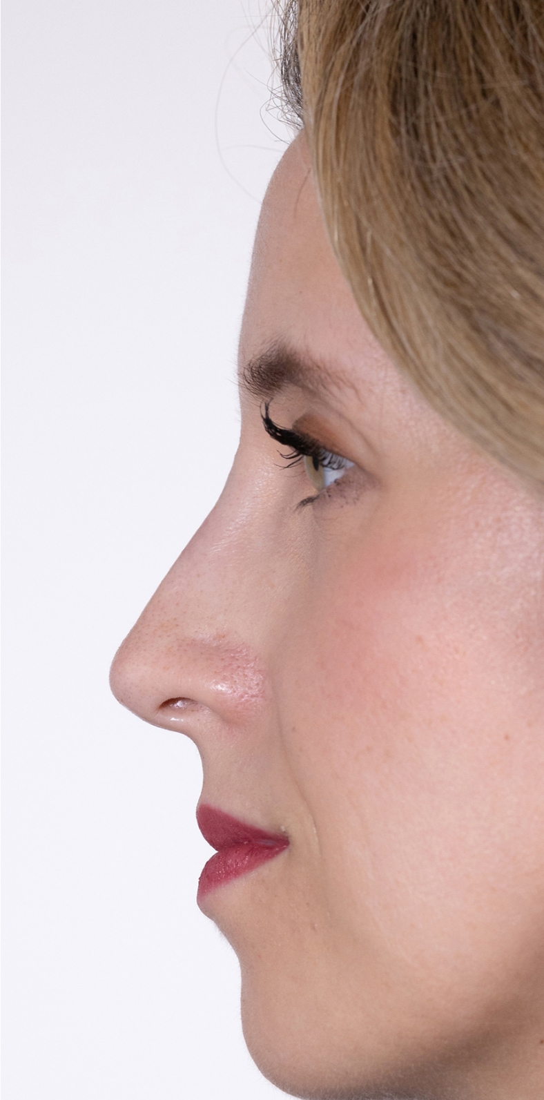 Nekirurška korekcija nosa - poslije, sl. 3 2022