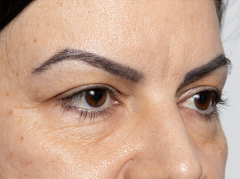 Morpheus8 zatezanjekože, sl. 1 - poslije