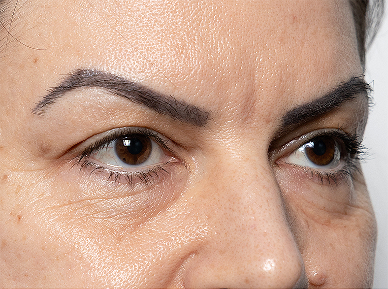 Morpheus8 zatezanjekože, sl. 1 - prije