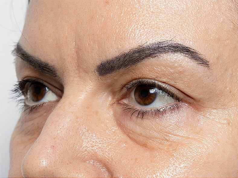 Morpheus8 zatezanjekože, sl. 2 - prije