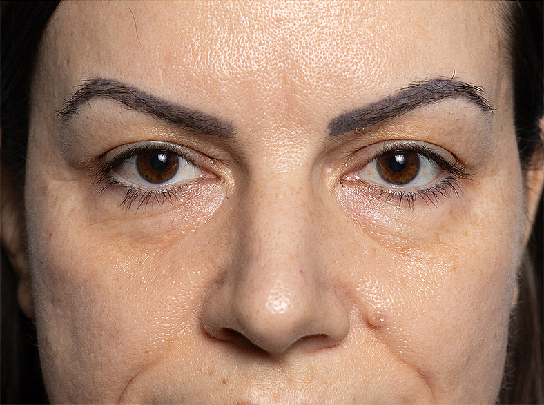 Morpheus8 zatezanjekože, sl. 3 - poslije