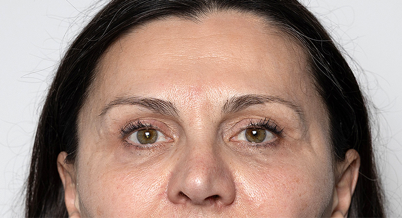 Nekirurško uklanjanje podočnjaka, poslije