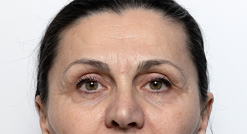 Nekirurško uklanjanje podočnjaka, prije