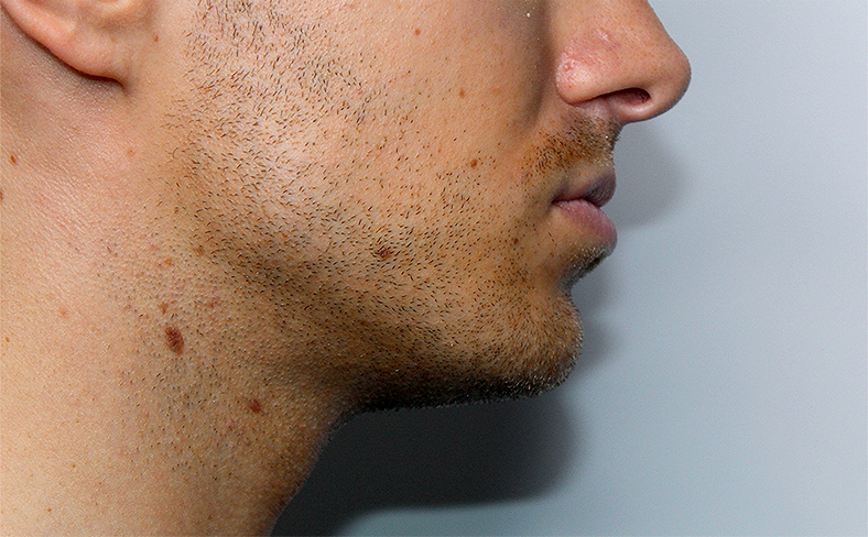 Oblikovanje brade i vilice dermalnim filerom, 2025. sl. 1 - poslije