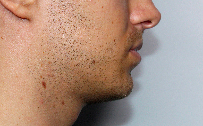 Oblikovanje brade i vilice dermalnim filerom, 2025. sl. 1 - prije