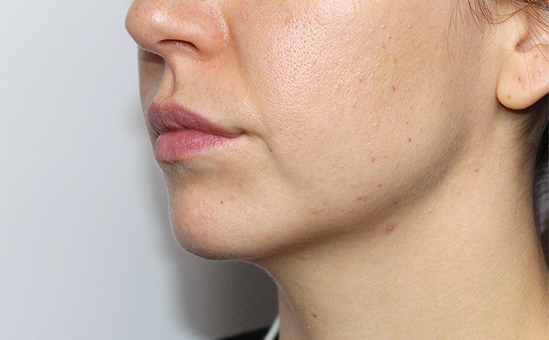 Oblikovanje brade i vilice dermalnim filerom, 2025. sl. 2 - poslije