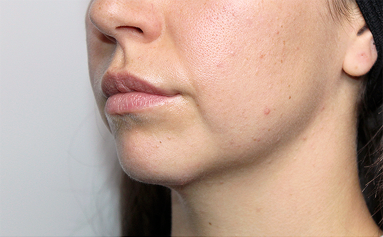 Oblikovanje brade i vilice dermalnim filerom, 2025. sl. 2 - prije