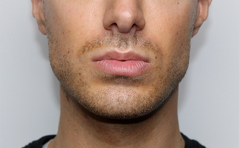 Oblikovanje brade i vilice dermalnim filerom, 2025. sl. 3 - poslije