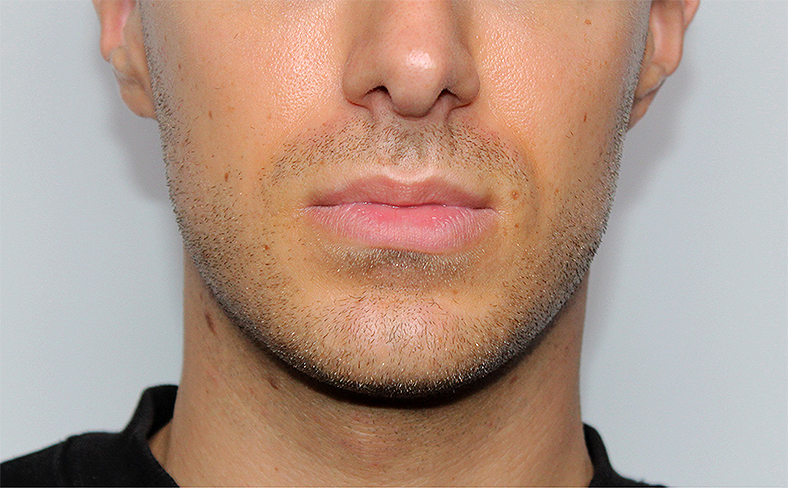 Oblikovanje brade i vilice dermalnim filerom, 2025. sl. 3 - prije