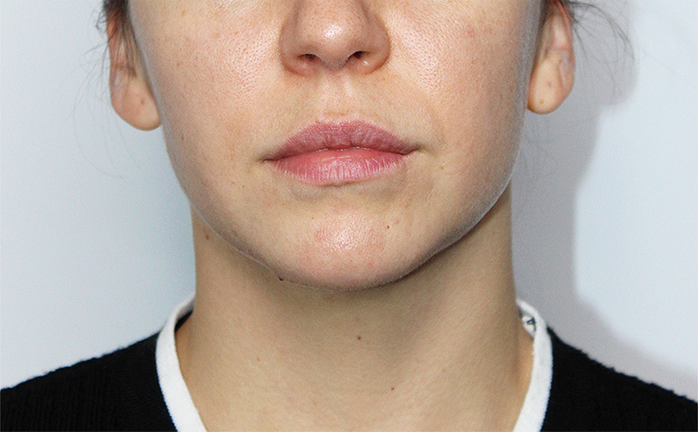 Oblikovanje brade i vilice dermalnim filerom, 2025. sl. 4 - poslije