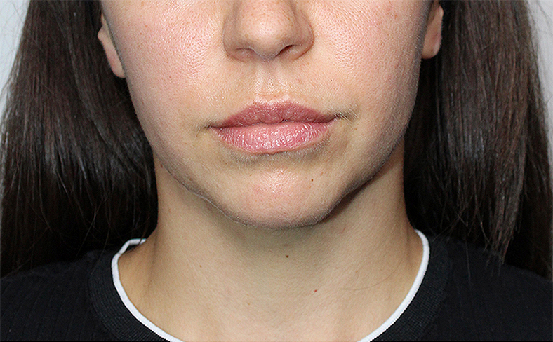 Oblikovanje brade i vilice dermalnim filerom, 2025. sl. 4 - prije