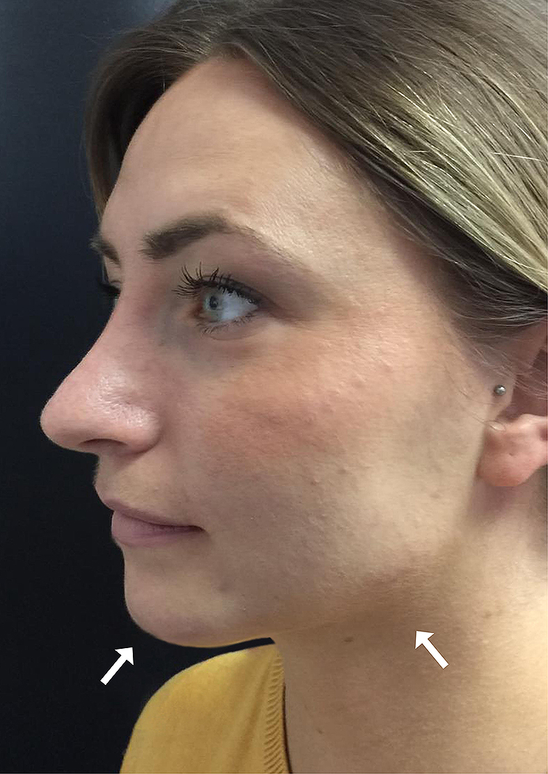 Oblikovanje brade i vilice, sl. 2 - poslije