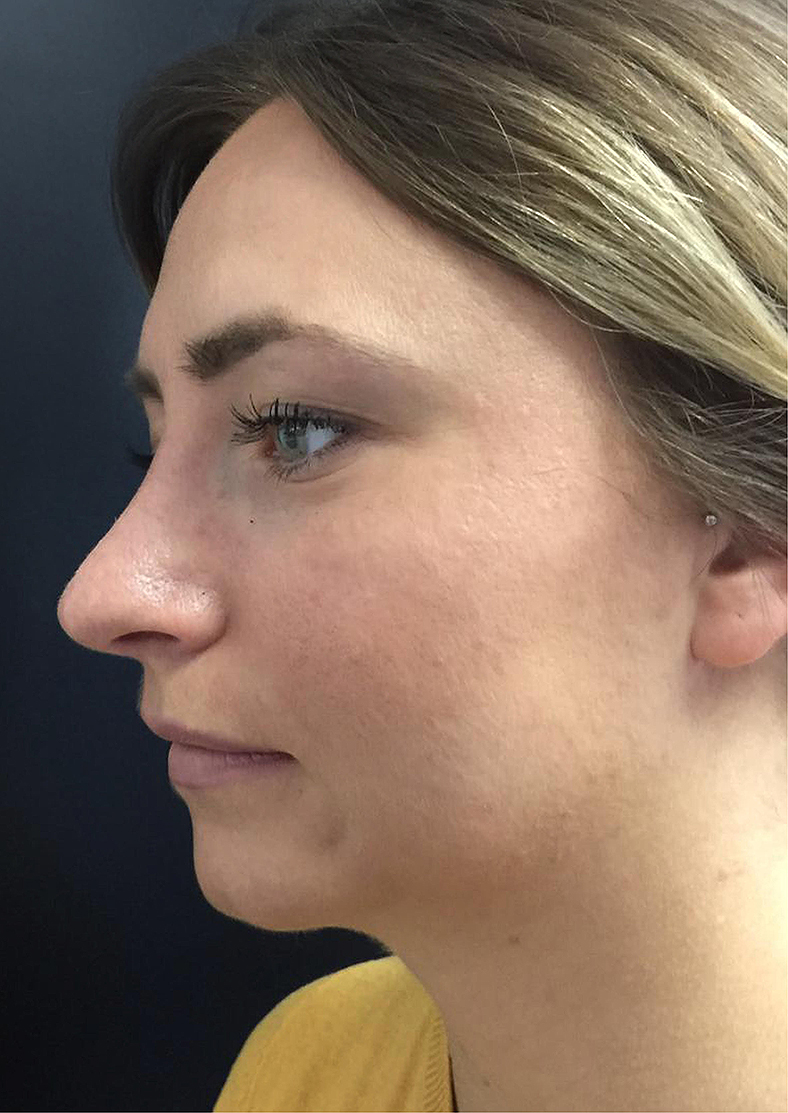 Oblikovanje brade i vilice, sl. 2 - prije