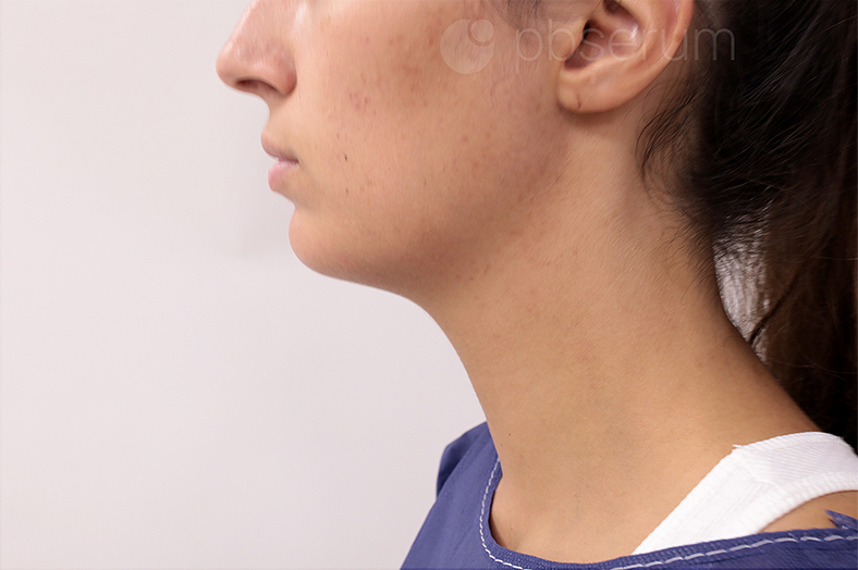 PB Serum, podbradak, sl. 2 - poslije