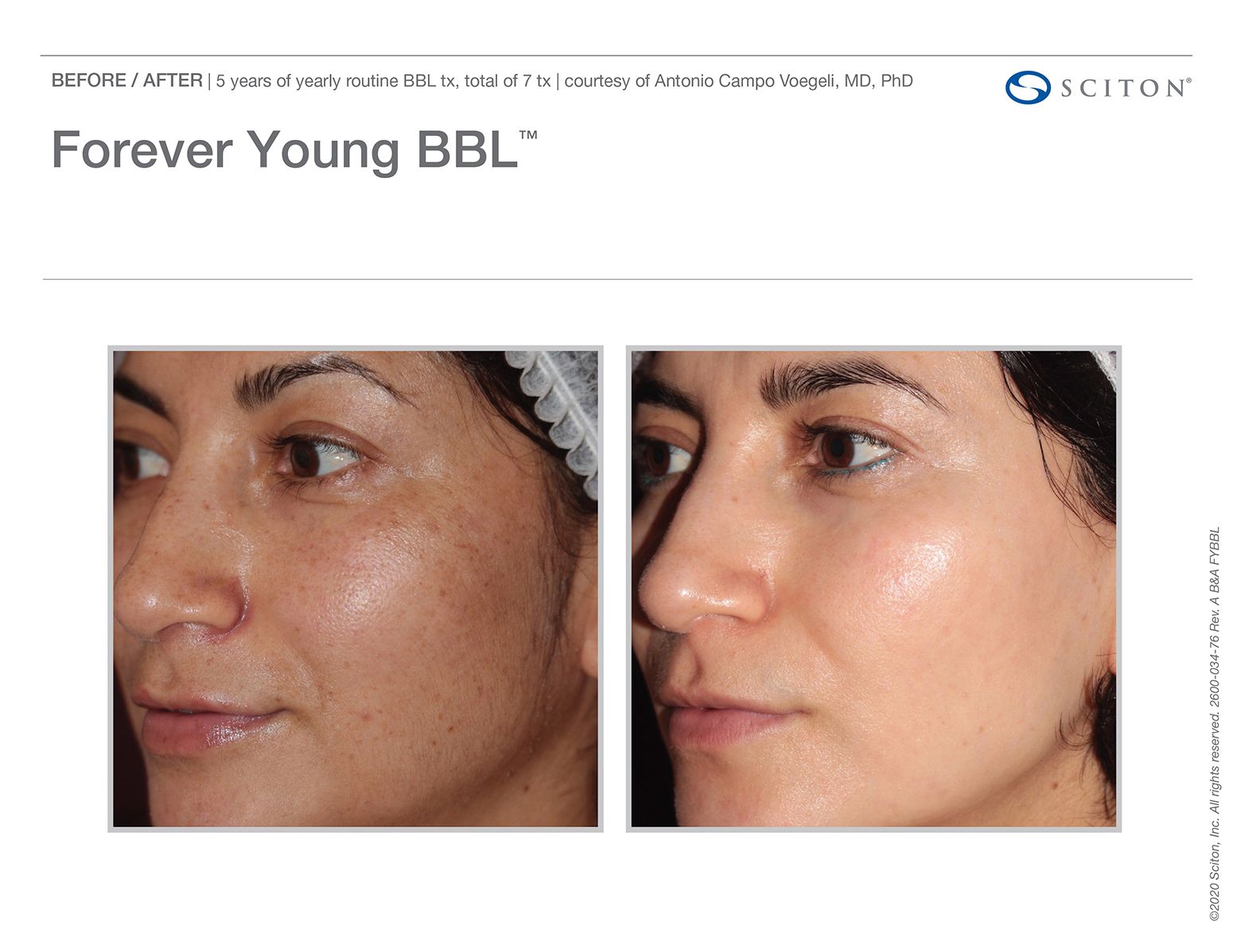 BBL HEROic Forever Young, sl. 1