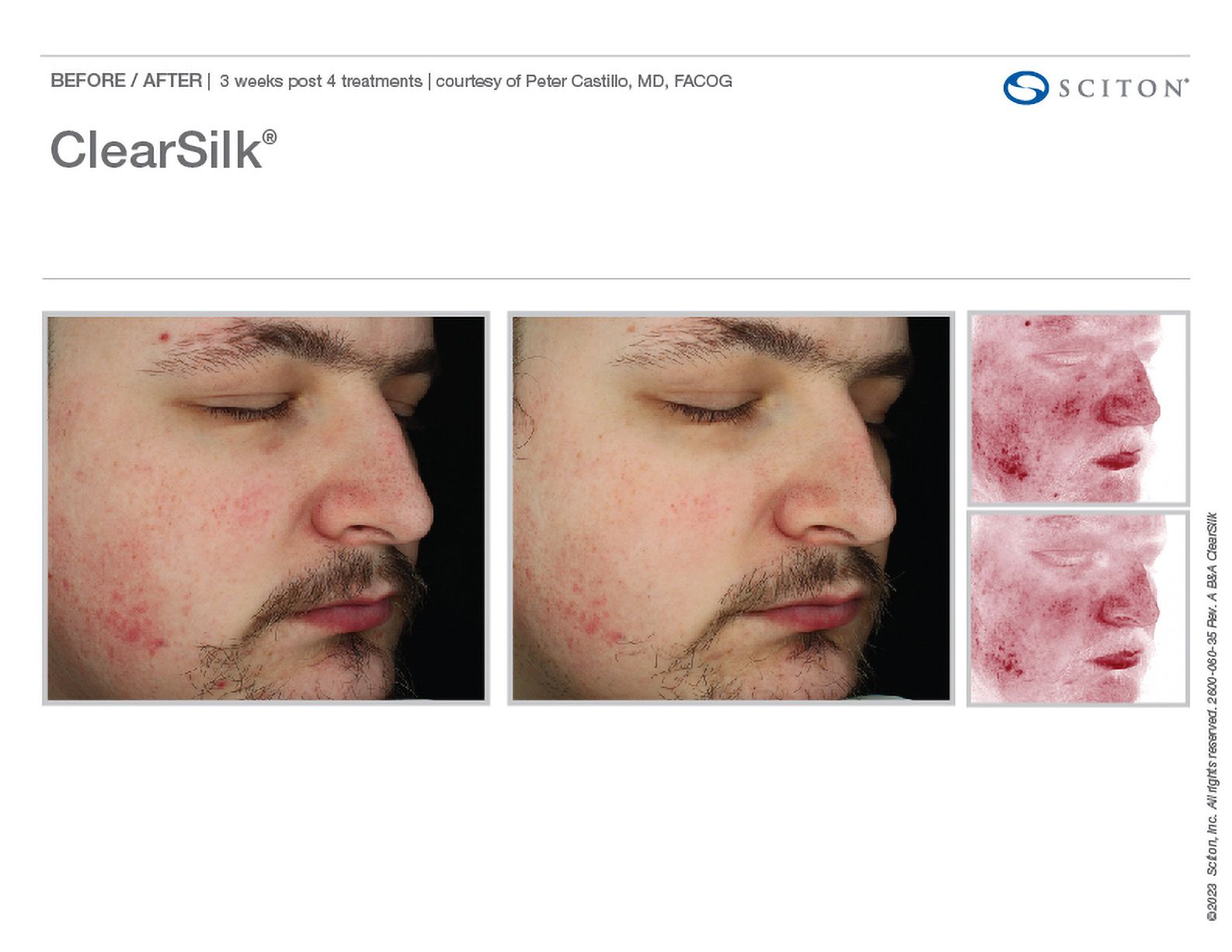 ClearSilk - pomlađivanje kože, sl. 4
