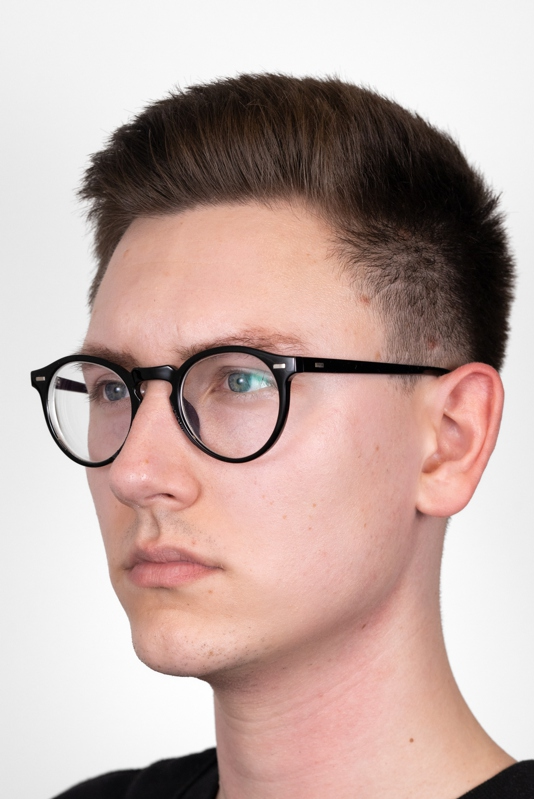 Oblikovanje brade i vilice, sl. 3 - prije