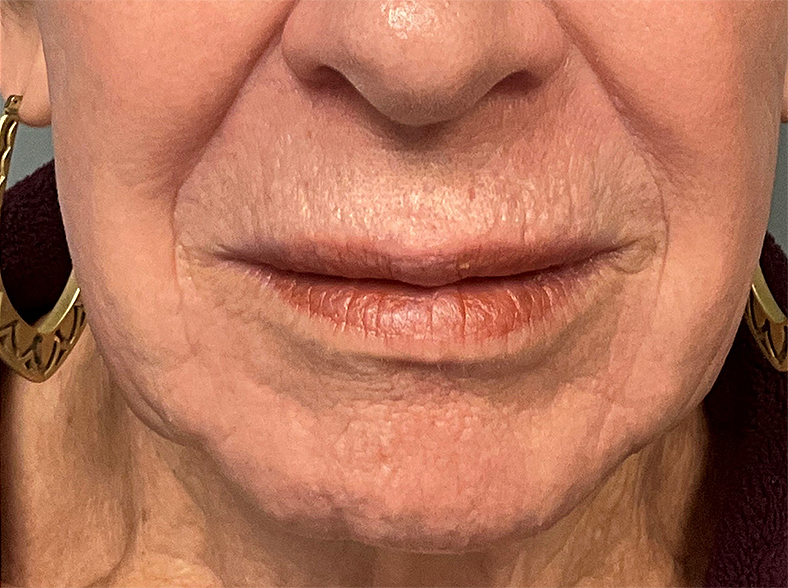 UltraClear frakcijski laser - sl. 2, poslije