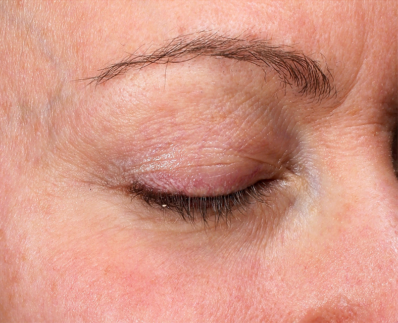 UltraClear frakcijski laser - sl. 3, poslije