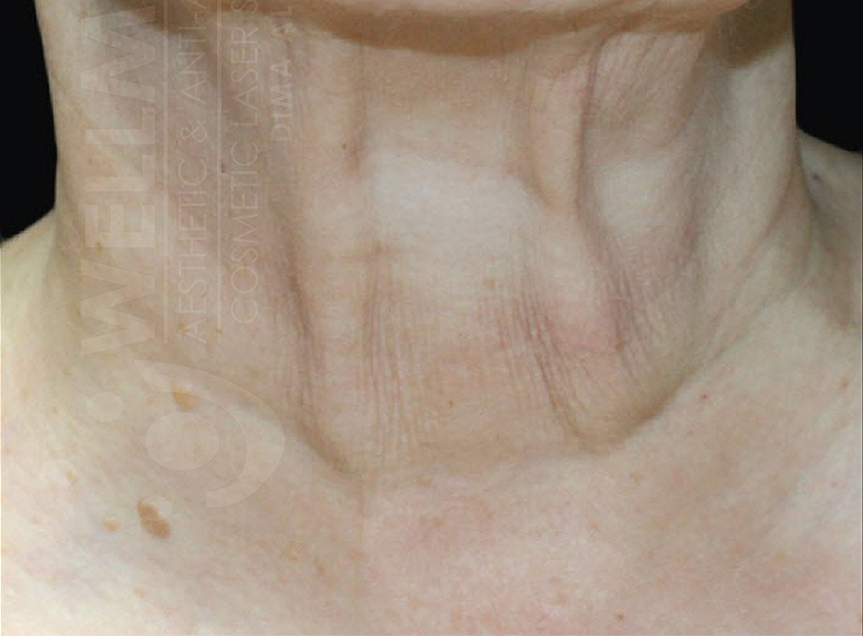 UltraClear frakcijski laser - sl. 5, poslije