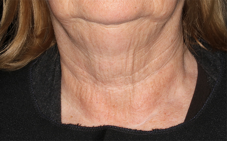 UltraClear frakcijski laser - sl. 8, poslije