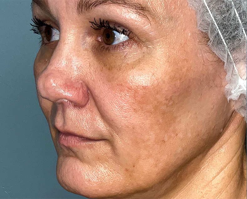 UltraClear frakcijski laser - sl. 10, prije