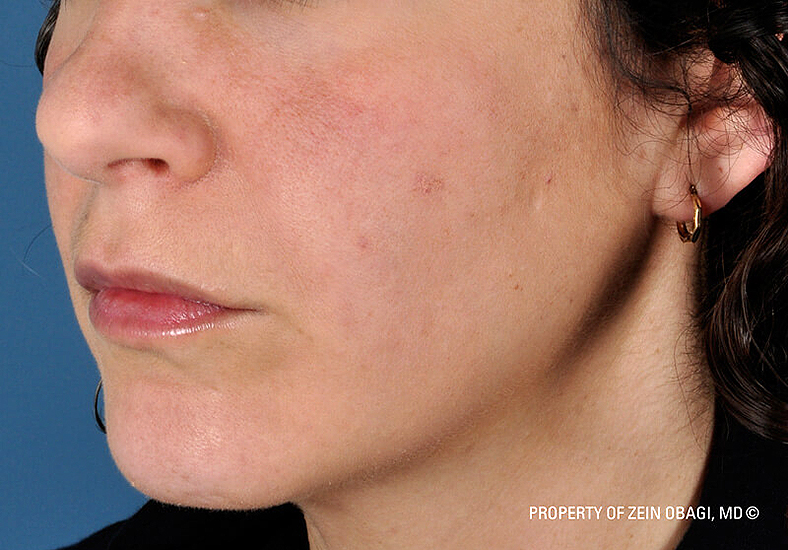 ZO Skin Health, sl. 1 - poslije