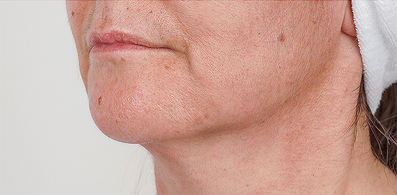 Zatezanje kože oko brade i vrata te augmentacija brade, sl. 4 - poslije