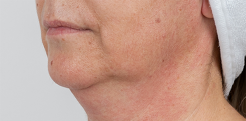 Zatezanje kože oko brade i vrata te augmentacija brade, sl. 4 - prije