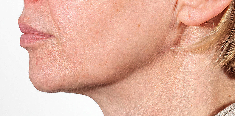 Zatezanje kože oko brade i vrata te augmentacija brade, sl. 2 - prije