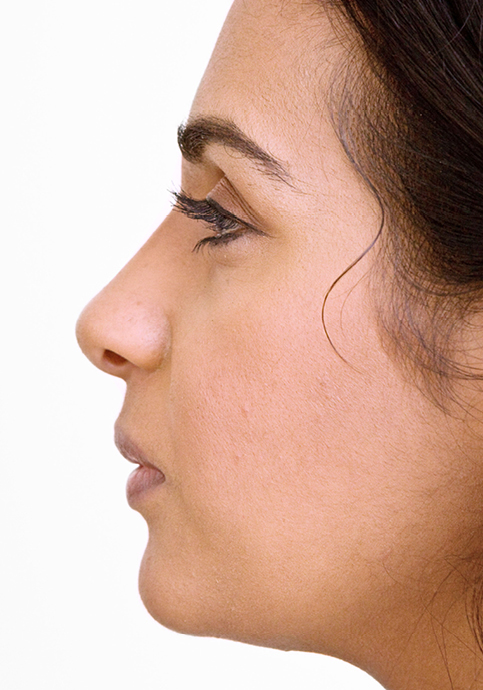 Nekirurška korekcija nosa - poslije