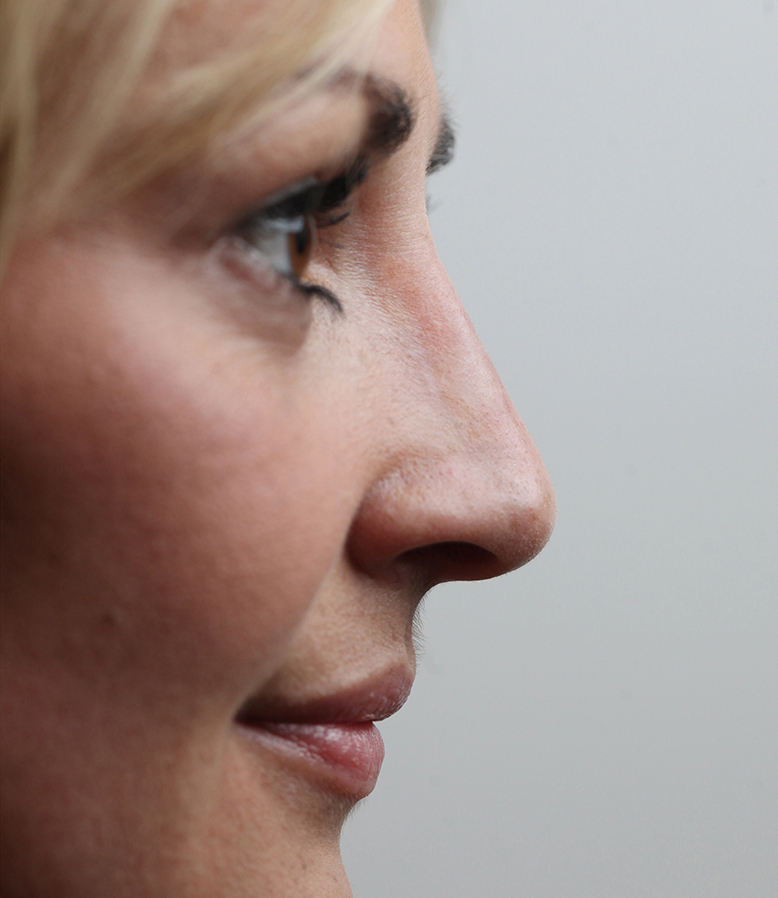 Nekirurška korekcija nosa - poslije