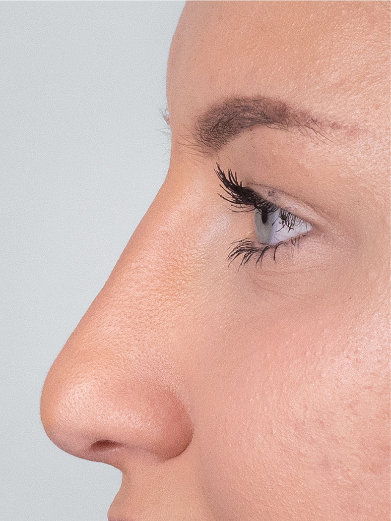 Nekirurška korekcija nosa - poslije, sl. 2