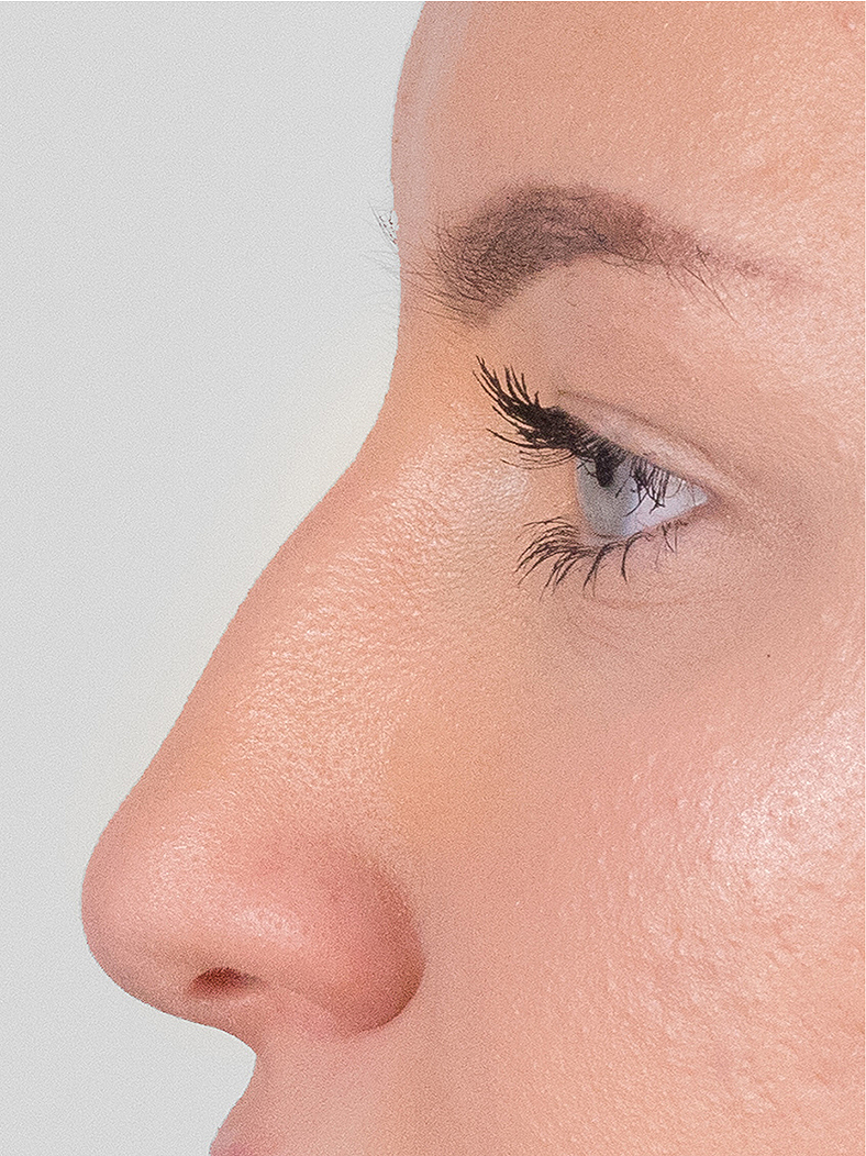 Nekirurška korekcija nosa - prije, sl. 2